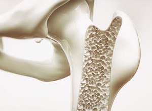 Osteoporóza - jak ji předcházet?